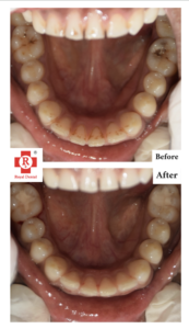 Filling and Root Canal before After