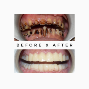 Full Mouth Rehabilitation and Bite Alignment