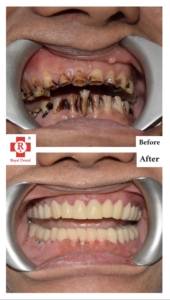 Full-Mouth Rehabilitation Before & After
