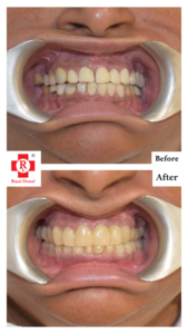 Teeth Straightening cosmetic dentistry