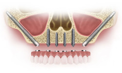 Implant-on-less-bone
