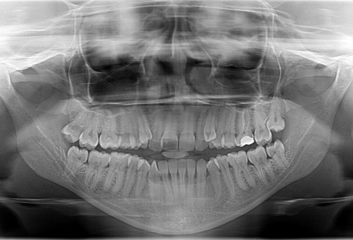 Orthognathic Jaw Surgery