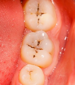 decayed and cavity tooth