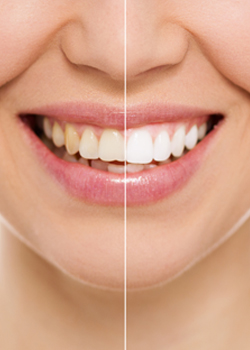 teeth whitening ar royal dental