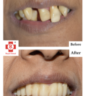 Tooth Mobility Before After Treatment