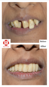 Tooth Mobility Before After Treatment