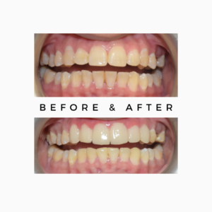 Tooth Mobility Makeover