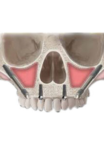 zygomatic implant in one day