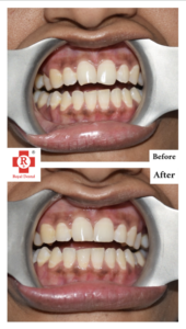 before After Filling and Root Canal