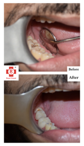 before After Root Canal Treatment