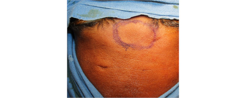 Before Treatment - Fat Grafting