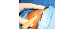 After Treatment - Fat Grafting