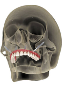 zygomatic dental implant