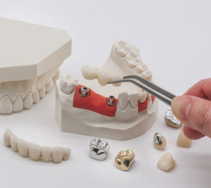 SAPTeeth dental material