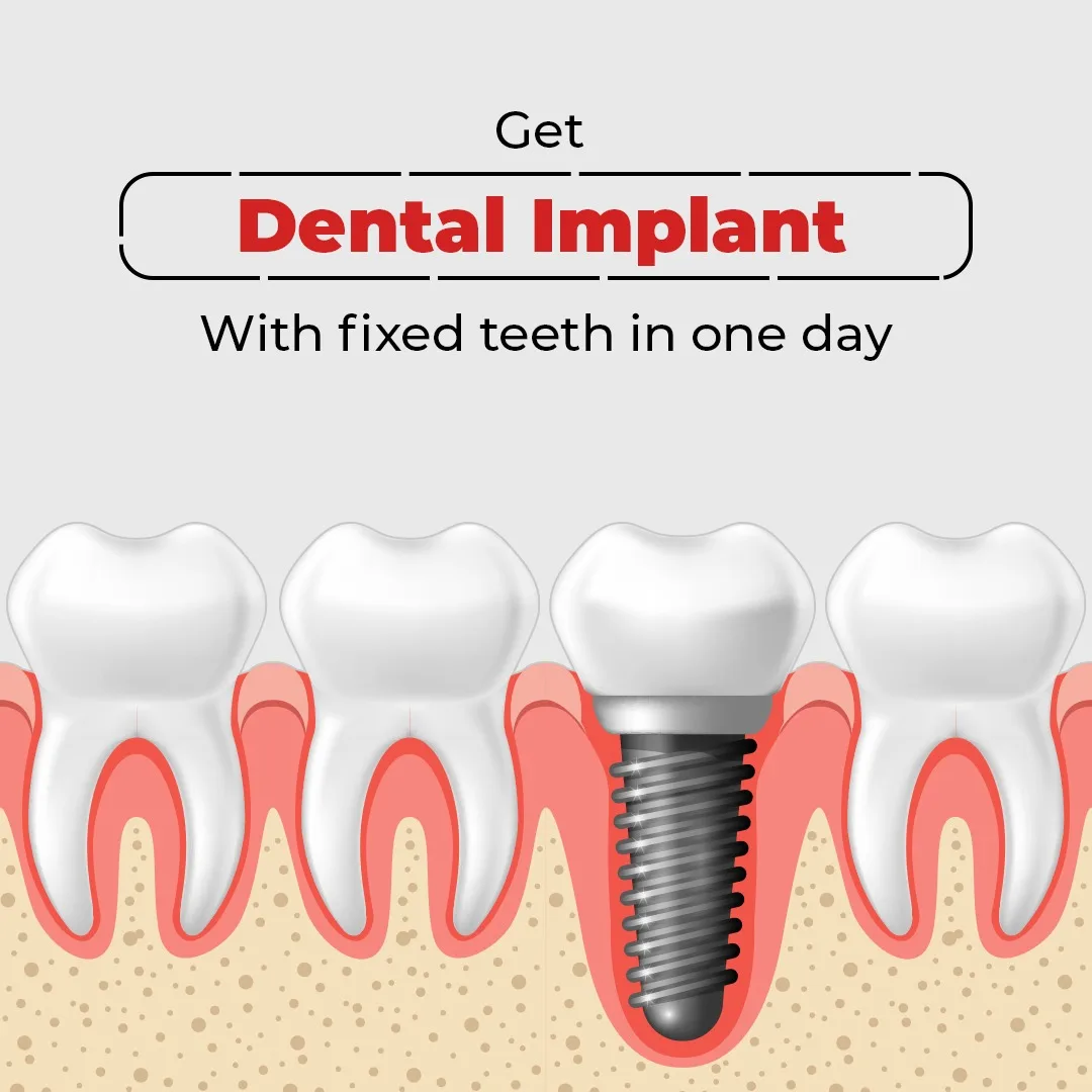 Teeth in a day | Royal Dental Clinics Kandivali East Mumbai