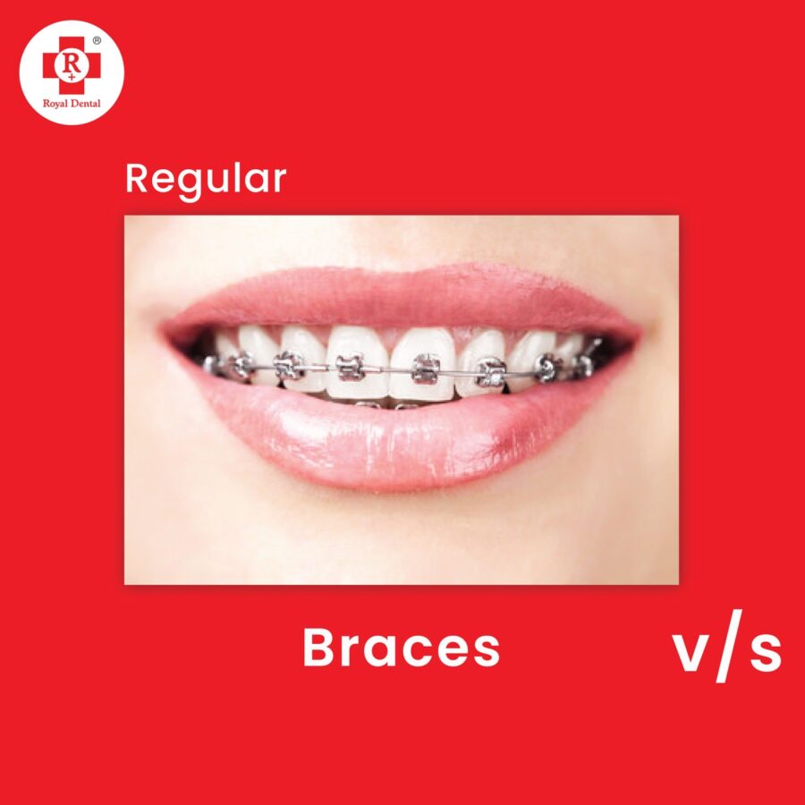 braces and carcinogenic