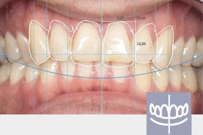 Tooth conturing for smile makeover |Royal Dental Clinics