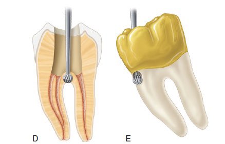Perforation during access opening | Dentist