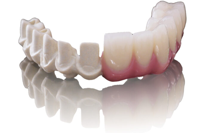 Advantages of PEEK as dental framework