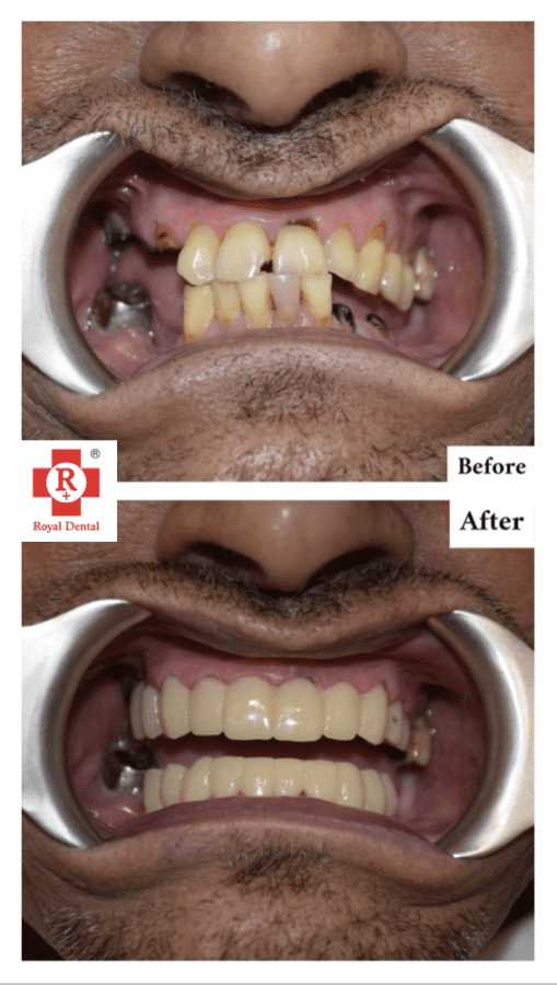 Dental Implants
