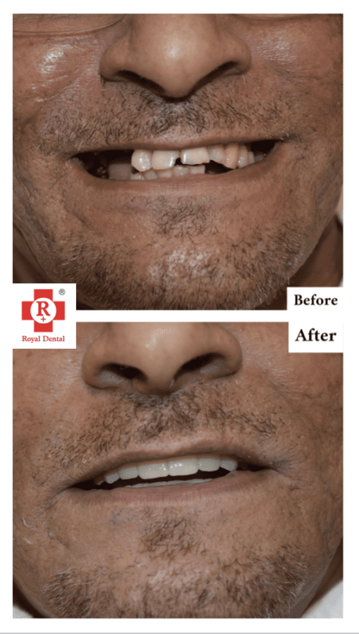 Dental Implants