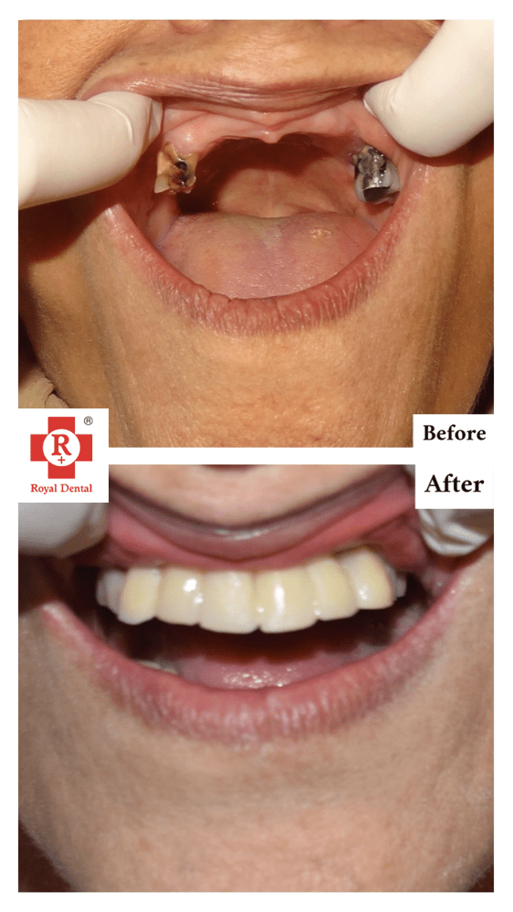 After Dental Implant