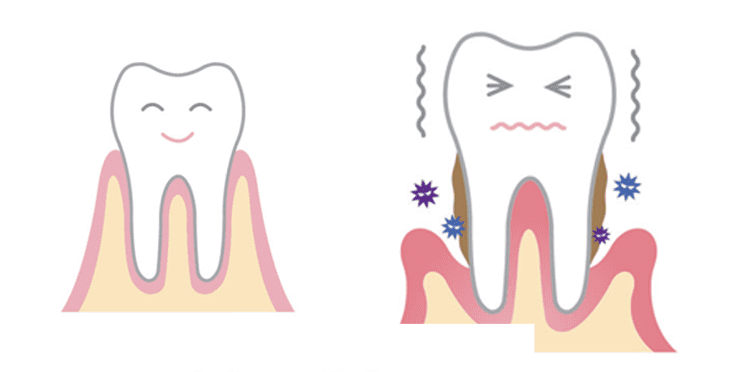 tooth mobility