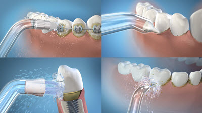 waterpik used in different teeth types