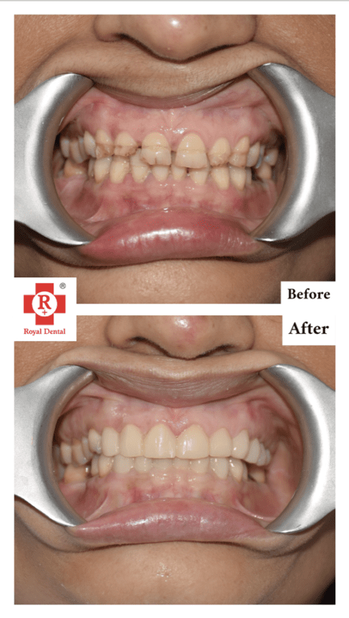 brittle teeth
