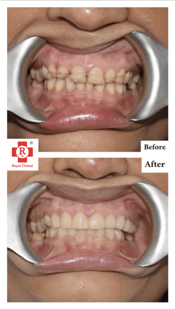 Brittle Teeth