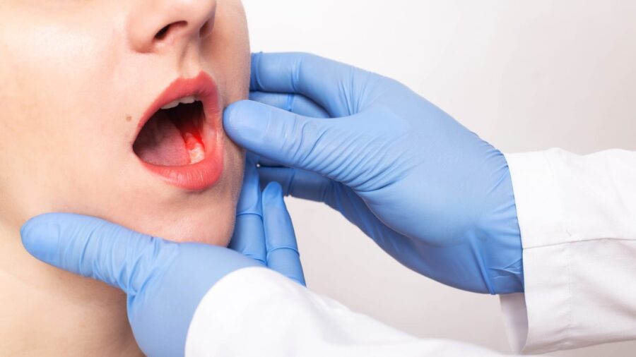cancer affected jaw