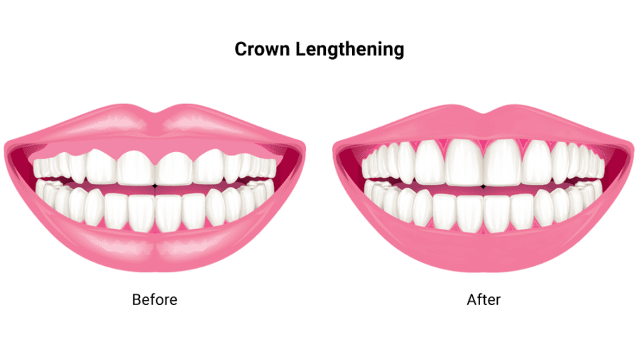 Crown Lengthening