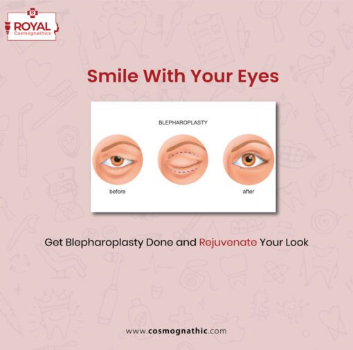 blepharoplasty eyelid