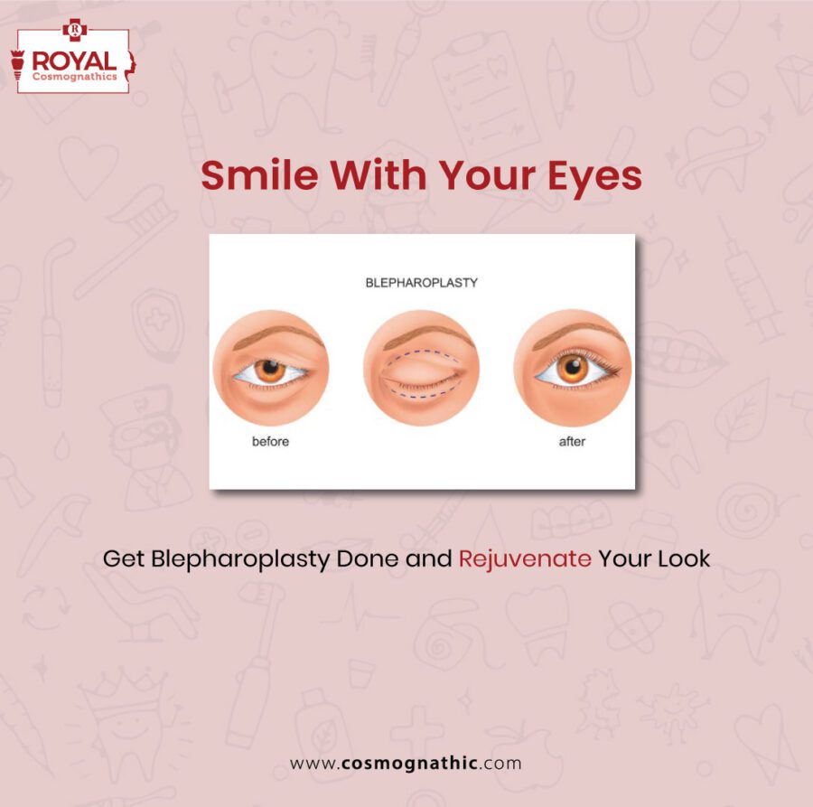 blepharoplasty eyelid surgery in mumbai 