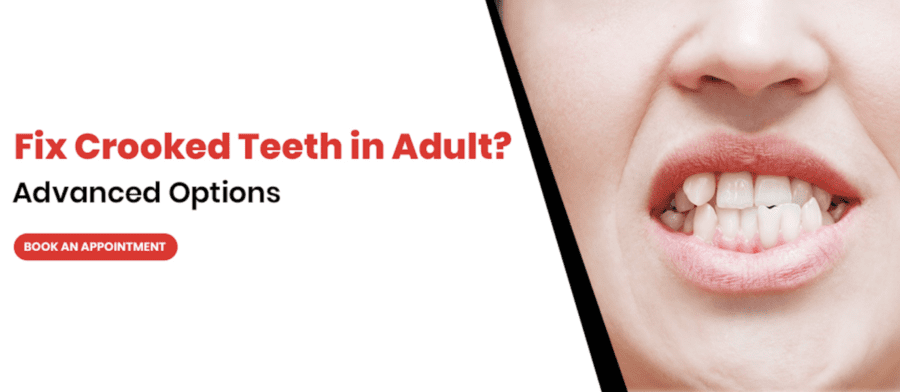 Same Day Cosmetic Treatment for Teeth Crowding