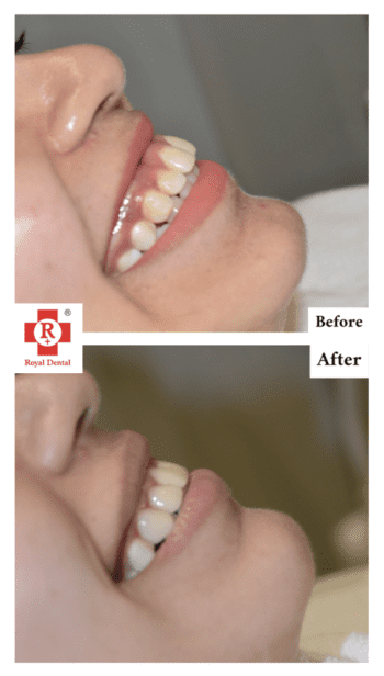 Crown Lengthening