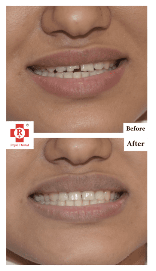 Chipped Crown