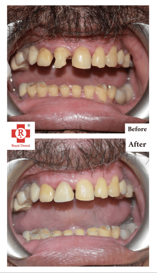 Broken Front Tooth