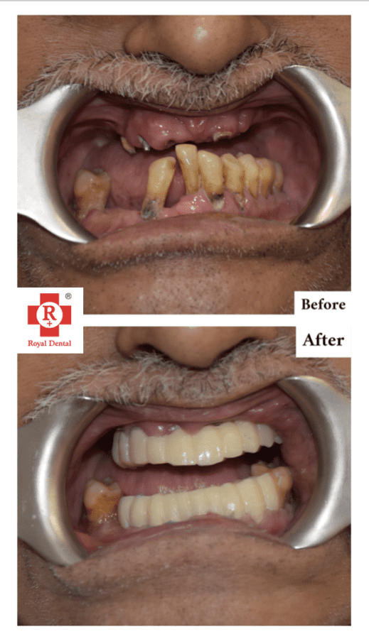Teeth Mobility