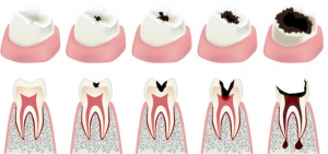 root canal dental treatment