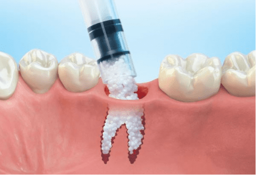 ../Parker-Dental-Group-Bone-Grafting.jpg