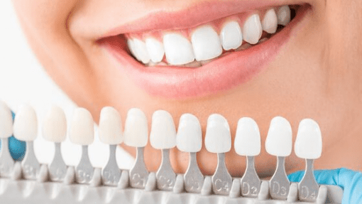 veneers cost in India