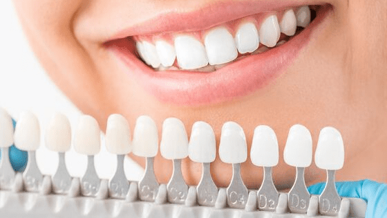 veneers cost in India