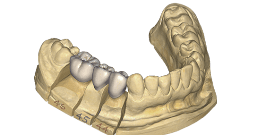 artificial dental crowns SAPTeeth