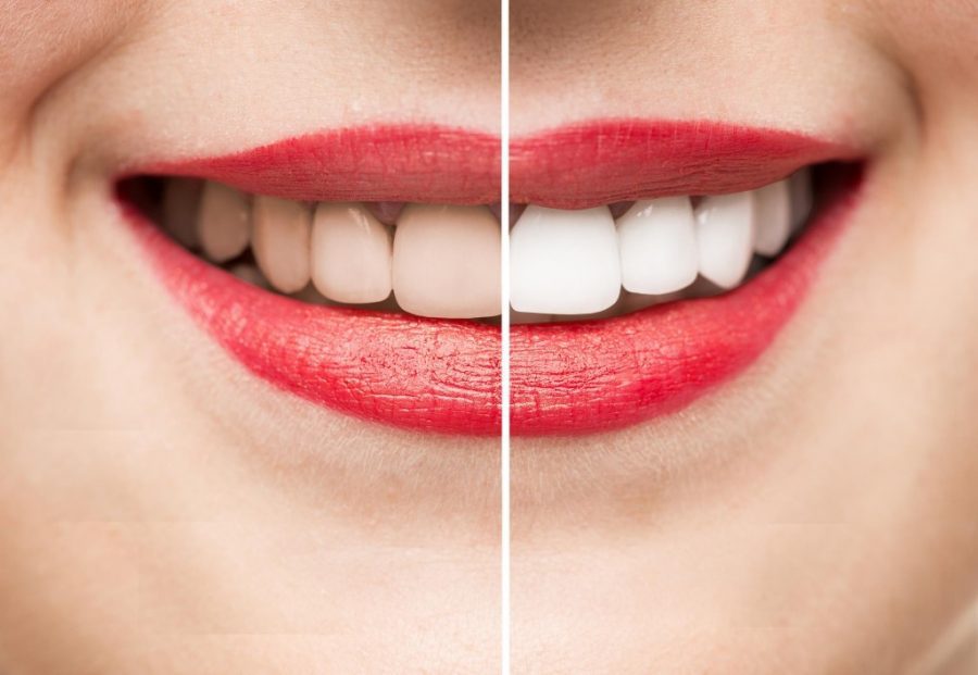 Sensitivity After Teeth Whitening - Teeth Yellow