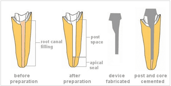 post and core
