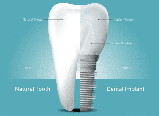 ../replace-roots-implants.jpg