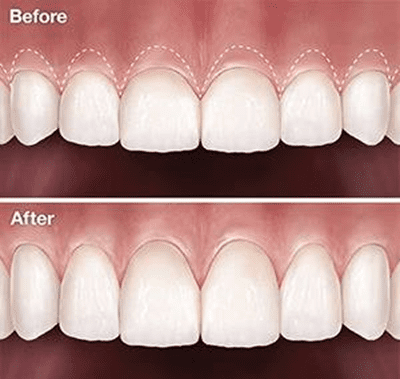 gummy smile - crown lengthening