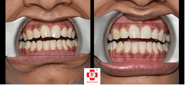 enameloplasty - regrow enamel