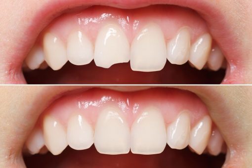 Cosmetic Tooth Contouring